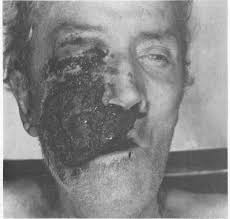 Rhinocerebral mucormycosis refers to an uncommon form of invasive fungal sinus infection. Appearance Of The Patient With Right Orbitofacial Mucormycosis Download Scientific Diagram