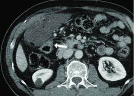 58 patients had reformatted ct with slice thickness ranging from 1 to 8 mm; Cystic Mesothelioma In A 64 Year Old Man The Contrast Enhanced Axial Download Scientific Diagram