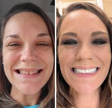 Hello everyone, 2 years ago I had surgery to get 21 teeth pulled and get  dentures well I unfortunately lost all my self confidence along with them  and I'll really like to