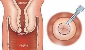 Image result for Friable Cervix