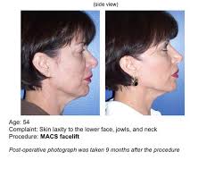 Facelift Surgery » UF Health Plastic Surgery and Aesthetics Center » UF  Academic Health Center » University of Florida