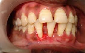 Image result for granuloma gum disease