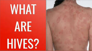 To prevent static buildup entirely, raise the humidity level in a room, moisturize your skin, or use an ionizer to rebalance the electrons in an area to prevent static from forming in the. Pin On How To Get Rid Of Hives Fast