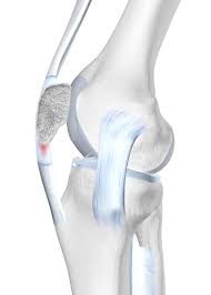 It causes pain and tenderness below the knee and limits activities. Irritation In The Patella Tendon Causes And Treatment Options
