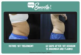 Before And After We Love Our Coolsculpting Results Cool Sculpting Coolsculpting Results Laser Hair Removal