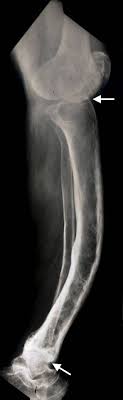 Paget S Disease Of Bone Symptoms And Treatment Orthoinfo Aaos