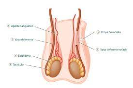 La vasectomía es un tipo de cirugía que previene que el hombre sea capaz de embarazar a una mujer. Vasectomia Bestane Urologia
