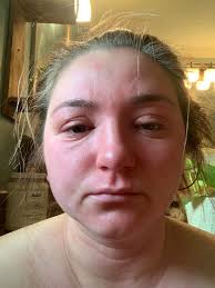 What causes skin reactions to ingredients like tallow, jojoba oil, and  frankincense?