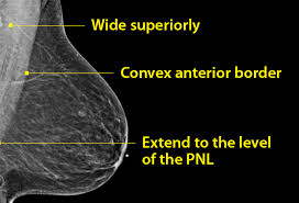 Additionally, if you place the shoulder in full extension it will stretch the clavicular pectoralis major, while full abduction stretches the lower pectoralis major. Capturing The Elusive Pectoralis Major In Mammography Beekspeak The Blog Of Beekley Medical