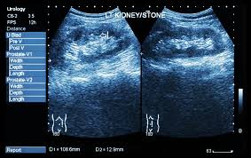 High blood pressure and diabetes are the two most common causes of kidney failure. Bilateral Renal Parenchymal Disease What Exactly Does It Mean