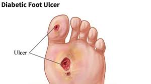 Check spelling or type a new query. Diabetic Foot Ulcer On Toe Diabeteswalls
