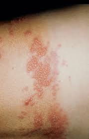 Ratgeber Herpes Zoster Medizin Schweiz