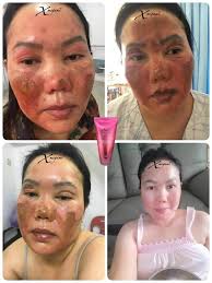 惊人的见证真实图被gas烧伤的脸蛋十天内修复肌肤损伤😍😍 MICAREE 见证不做假‼️