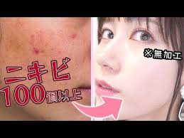 100個以上できたニキビを全滅させた私のスキンケア方法 youtube 輝く肌 ニキビ スキンケア