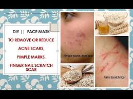 Alpha hydroxy acid cream can also help heal the scar. How To Remove Pimple Marks Acne Scars Nails Scratch Scar Diy Have Spotless Skin Youtube