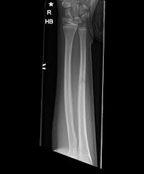 Image result for Forearm Fracture