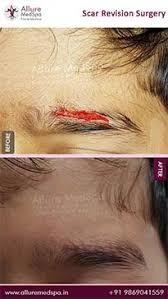 Scar revision surgery can boost confidence and allow individuals to feel more at home in their bodies. Scar Revision Surgery Scar Removal Treatment Cost In Mumbai India