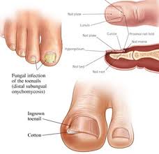 Toenail Fungus Treatment 2020 Top Foot Doctor Podiatrist Nyc