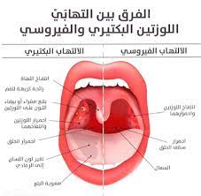 الفرق بين الالتهاب الحلق الفيروسي مختبرات تكنولاب الطبية facebook