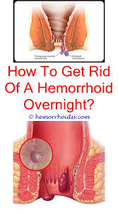 Pin On How To Treat Hemorrhoids