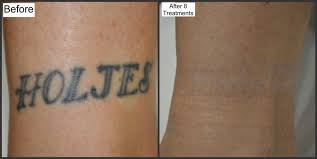 Body contouring & fat reduction. Tattoo Removal W Picosure Melbourne Fl