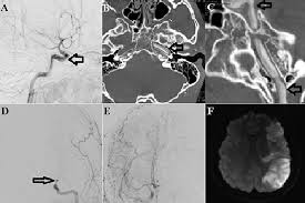 Carotid dissection is a breakdown of the layers of the carotid artery that causes the wall to tear. A C Intracranial Carotid Artery Dissection Started From Petrous Download Scientific Diagram