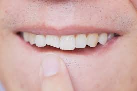 How do you know if a tooth is infected. What Is A Tooth Abscess And What Can You Do About It