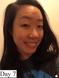 Dùng thử toner giấm táo trị mụn “thần thánh”, cô nàng này đã rút ra kết  luận đau thương