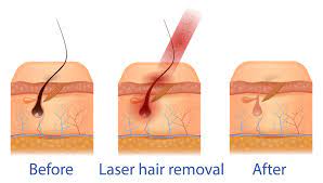 I have very dark pubic hair and fair skin. Brazilian Laser Hair Removal For Men Vs Medspa Laser Clinic