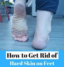 Adding a little foot care to your grooming routine on occasion (once a month) may be exactly what you need to earn yourself. How To Get Rid Of Dead Skin On Feet Step By Step Guide Dead Skin On Feet Dry Skin On Feet Hard Skin On Feet