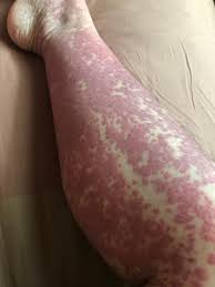 Image result for Vasculitis