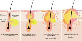 Why Does My Nose Get So Oily Compared To The Rest Of My Face? - Quora