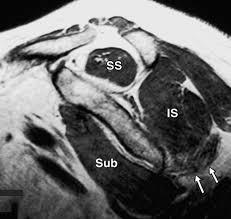 Parsonage Turner Syndrome Mr Imaging Findings And Clinical Information Of 27 Patients Radiology