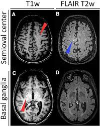 Developmental Dilatation Of Virchow-Robin Spaces: A Genetic Disorder? -  Sciencedirect