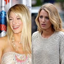 Big Fun Voor En Na 10x Celebs Met Een Nose Job