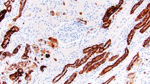 In following years patient had multiple and extensive surgical procedures . Pathology Outlines Cytokeratin 7 Ck7 K7