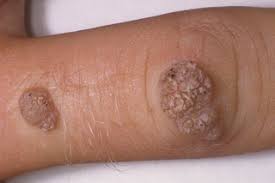 Check spelling or type a new query. Warts And Verrucas Nhs