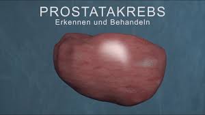 Prostatakrebs Symptome Diagnose Behandlung Heilungschancen Prostata De