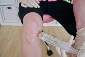 Ozone injections have been found to be an extremely safe medical therapy, free from side effects. How To Do Subcutaneous Ozone Knee Injections