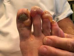 The gel material absorbs a lot (repeat, a lot) of shear via. Toe Blisters Archives Fixing Your Feet
