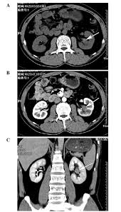 In acute glomerulonephritis, nephrotic syndrome, and in. Inflammatory Myofibroblastic Tumor Of Renal Pelvis Presenting With Iterative Hematuria And Abdominal Pain A Case Report