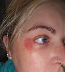 I have this red, dry, flaky patch right next to my eye that hurts and won't  go away…any suggestions?