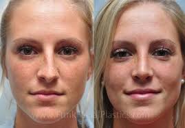 Body Height And Rhinoplasty Planning Best Rhinoplasty Rhinoplasty Before And After Rhinoplasty Rhinoplasty Nose Jobs