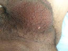 Bolita En Testiculos Resuelto Sexualidad Ccm Salud