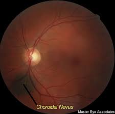 Image result for nevus sclerae