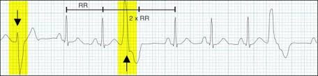 A premature ventricular contraction (pvc) — also known as a premature ventricular complex, ventricular premature contraction (or complex or complexes) (vpc), ventricular premature beat (vpb), or ventricular extrasystole (ves) — is a relatively common event where the heartbeat is. Basic Ecg Ekg Interpretation Of Common Arrhythmias
