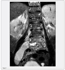 Juniper Publishers Pott S Disease A Diagnosis That Should Never Be F Diagnosis Reproductive Medicine Complementary Medicine