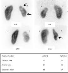 Renal clearance is greater in healthy. How To Do A Dmsa Scan Springerlink