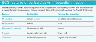 Image result for Post-MI Pericarditis