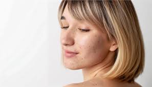 Image result for Postinflammatory Hyperpigmentation